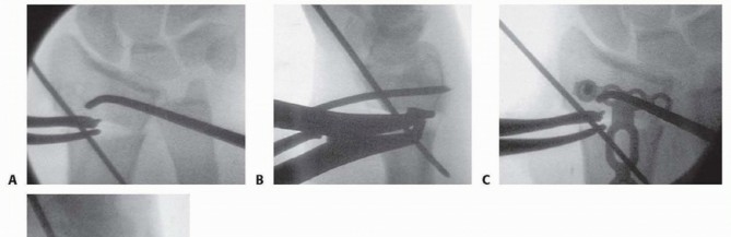Illustration 21 for Precision Correction for Distal Radius Malunion