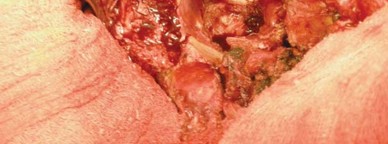 Illustration 45 for Navigating Early THA for Fractures of the Acetabulum
