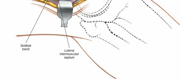 Illustration 229 for Mastering Knee Approaches: Spotlight on Superficial Medial Ligament