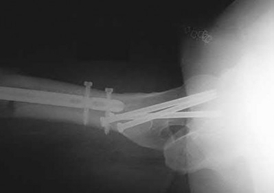 Illustration 112 for OrthoCash: Trauma MCQs & Cases for a yearold woman