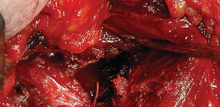 Illustration 68 for Unlock the Figure Posterior Approach to the Hip