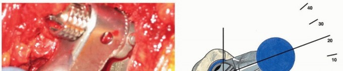 Illustration 21 for Recreate Hip Biomechanics: Modular Stems for Modular Solutions