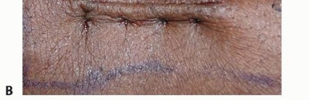 Illustration 18 for Distal Radius Fixation: Precision Through Lister's Tubercle