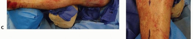 Illustration 38 for Tibia External Fixation: See How Pins Are Placed for Healing