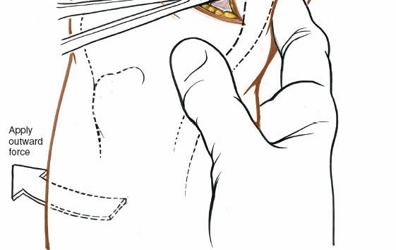 Illustration 60 for Mastering Knee Approaches: Spotlight on Superficial Medial Ligament