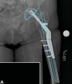 Illustration 13 for THA for patients with proximal femoral deformity: Practical solutions