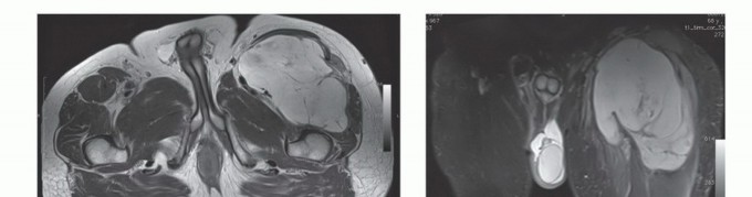 Illustration 8 for Limb-Sparing Quadriceps Resection: Superficial Femoral Artery