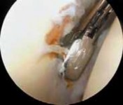 Illustration 16 for Capsular Releases for Loss of Motion: Restore Your Shoulder