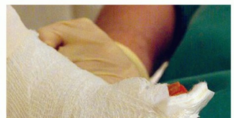 Illustration 11 for Mastering Extensive Plantar Release for Hallux Rigidus