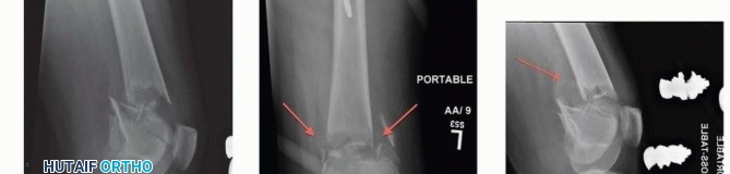 Illustration 21 for Repairing Distal Femur Fractures: Open Reduction & Internal Fixation