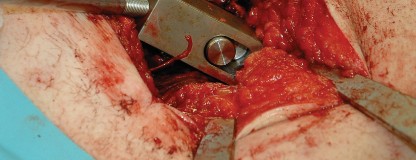 Illustration 11 for Femoral Stem Revision: Posterior Approach for Better Outcomes