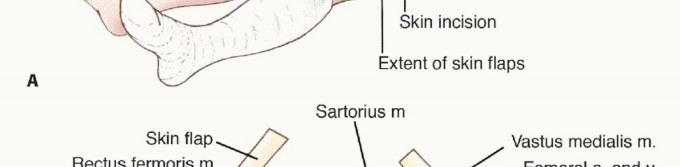 Illustration 13 for Limb-Sparing Quadriceps Resection: Superficial Femoral Artery