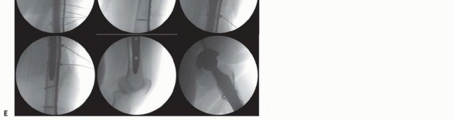 Illustration 28 for Mastering Fixation of Periprosthetic Fractures of the Femur