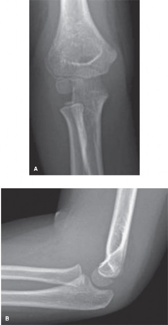 Pediatric Elbow Cases: Why the Internal Oblique View is Key