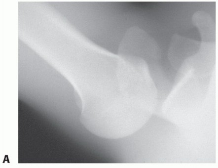 Illustration 2 for Finally Treat Recurrent Posterior Instability of the Shoulder