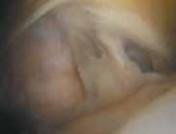 Illustration 14 for Resolving Femoral Head Neck Impingement: Arthroscopic FAI Solutions