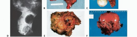 Illustration 27 for Surgical Pelvic Resection: Gluteus Maximus Muscle & Nerve Preservation