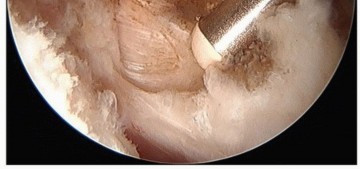 Illustration 13 for Hip Pain Relief: Arthroscopy for Nonstructural Pathology