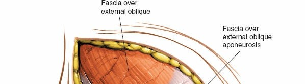 Illustration 8 for Ilioinguinal Approach: Master the Deep Inguinal Ring for Success
