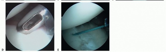 Illustration 5 for Mastering the Treatment of Recurrent Posterior Shoulder Instability