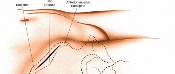 Illustration of bone graft anterior - Dr. Mohammed Hutaif