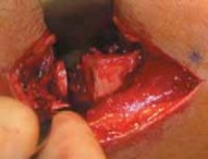 Illustration 4 for Conquering Adolescent Blount's Disease: A Surgical Guide