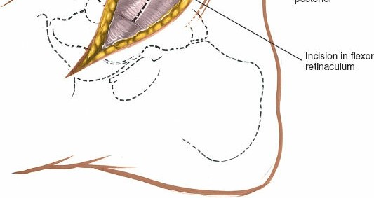 Illustration 28 for Optimized Approaches to the Dorsum of the Foot & Ankle