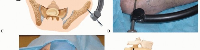 Illustration 31 for Emergency Fixation of the Pelvis: Control Bleeding & Restore Stability
