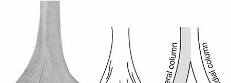 Illustration of distal humerus fractures - Dr. Mohammed Hutaif