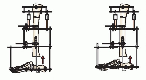 Illustration 18 for Beyond Amputation: Circular Fixation for Infection of the Talus