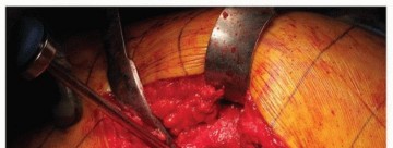 Illustration 28 for Uncemented Acetabular Revision: Optimizing Hemispherical Cup Use