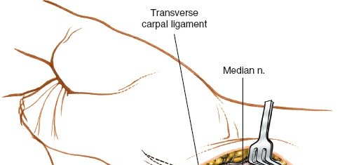 Illustration 21 for Volar Approach: Optimal Exposure for the Volar aspect of the Distal Radius
