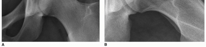 Illustration 9 for Beyond Knee Surg: Hip Arthroscopy for Sports Injuries