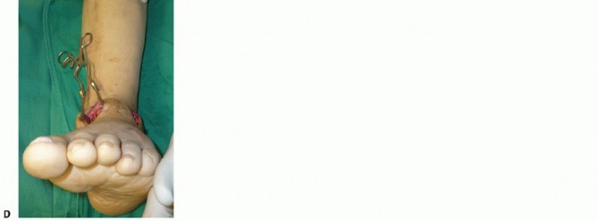 Illustration 39 for Optimize Pain Management with Proximal Ring Block for Ankle Arthrodesis