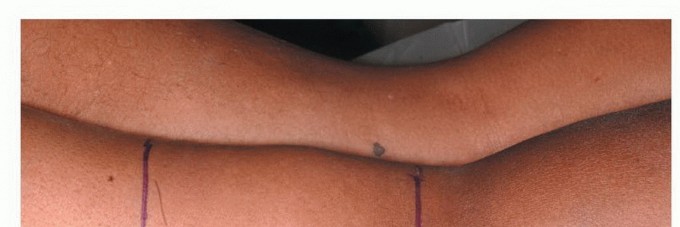 Illustration 6 for Complex Popliteal Resections: Protecting the Greater Saphenous Vein