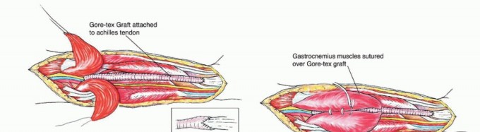 Illustration 11 for Soleus Resection for Tumors: Protecting the Heads of the Gastrocnemius