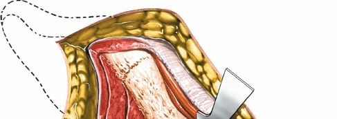 Illustration 50 for Unlocking Every Aspect of the Hip's Surgical Approaches