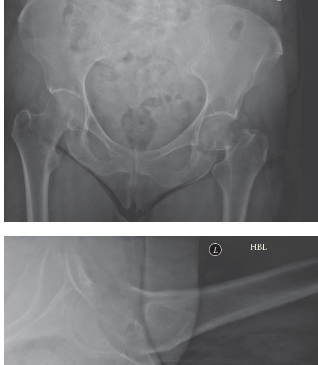 Illustration of intracapsular hip fracture - Dr. Mohammed Hutaif