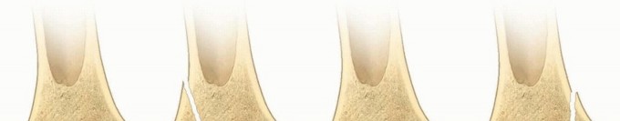 Distal Femoral Physeal Fractures: Key to Preventing Long-Term Issues