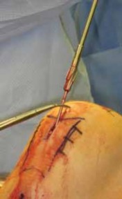 Illustration 48 for Optimal Nailing of the Tibia: Techniques for Challenging Fractures