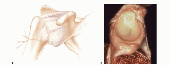 Illustration 3 for Bankart Repair & Inferior Capsular Shift: Solving Shoulder Instability