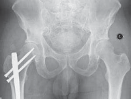 Illustration 24 for Advanced Arthroplasty for Malignant Lesions: Reclaim Your Mobility