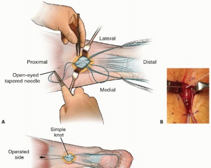 Decoding Mini-Open Repair for Achilles Tendon Ruptures