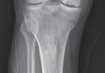 صورة توضيحية لـ استبدال مفصل الركبة بالحد الأدنى من التدخل الجراحي: ألم أقل وتعافٍ أسرع مع النهج شبه الرضفي الإنسي