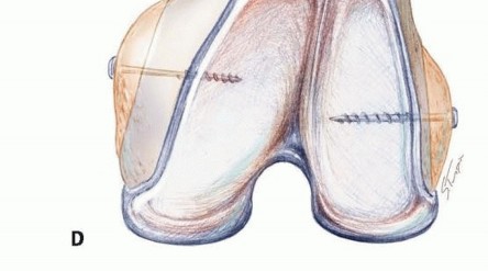 Illustration 10 for Optimizing Revision Femoral Component with Distal Femoral Bone Loss