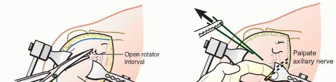 Illustration 13 for Hemiarthroplasty for Proximal: Effective Treatment for Fractures