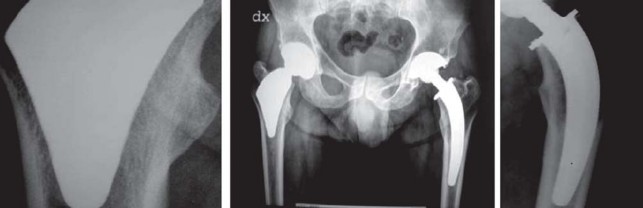 Illustration 34 for The Proxima: Why This Proximally Loading Implant Preserves Bone