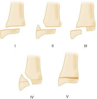 Illustration 7 for Pediatric Buckle Fracture: When is a Velcro Wrist Brace Best?