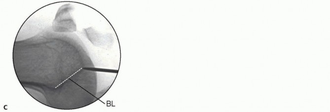 Illustration 2 for Retrograde Femoral Nailing: Optimizing Surgical Outcomes