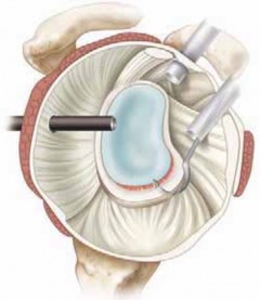 Illustration 20 for Regain Stability: Anterior Shoulder Instability Arthroscopic Fix